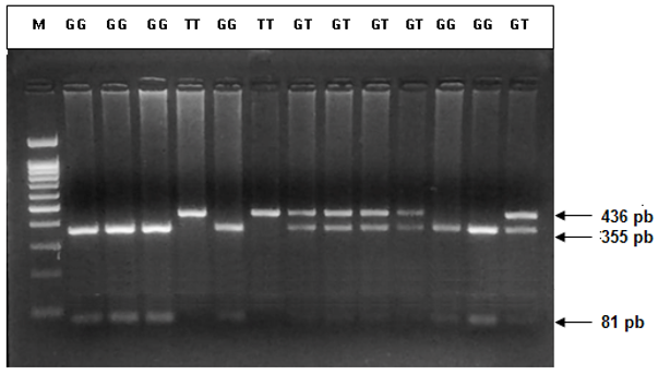 Figure 1. RFLP-PCR products of MUC5B promoter polymorphism. GG genotypes are deduced in presence of two fragments (355 and 81 bp); TT genotypes are deduced with the unique 436 bp undigested fragment. GT genotypes are deduced in presence of the three fragments. 