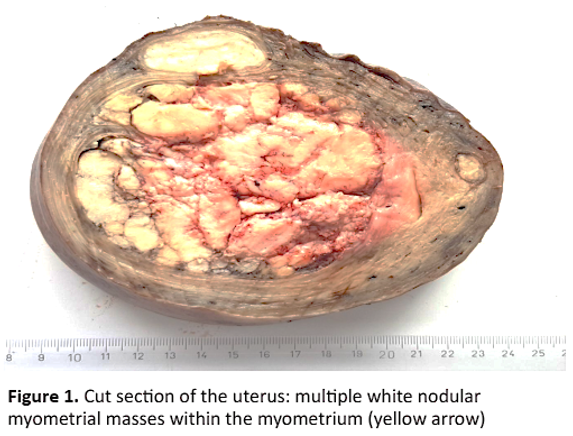 uterus