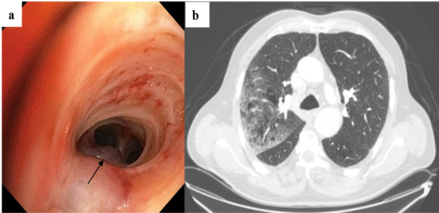 Figure 2. (a) Protruding polypoid formation in the right upper lobar apical bronchus (black arrow) (endo-bronchial metastasis of renal cell carcinoma). (b) Axial slice in lung parenchyma 