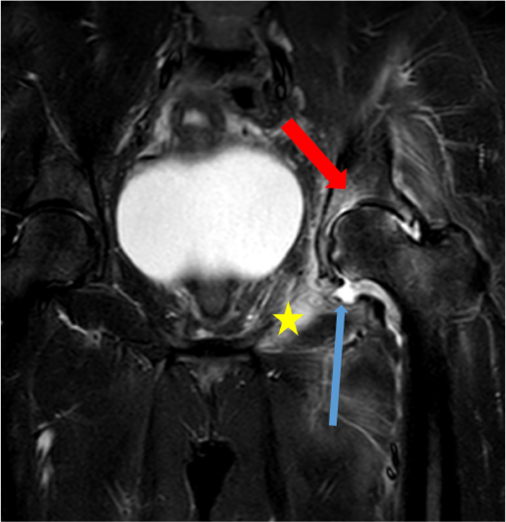 Figure 3 : MRI showing coxitis with intra-articular effusion, bone marrow edema, soft tissue edema and joint space narrowing with irregularities of the articular surfaces