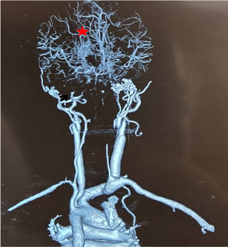 Figure 1: Computed tomography angiography of the supra-aortic and cerebral vessels showing long occlusions of both internal carotid arteries (black arrow) with extensive collateral vascular networks consistent with Moyamoya syndrome (red asterisk) in a patient with mucopolysaccharidosis type I